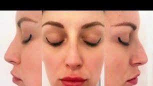 'Rhinoplasty Surgery (Before & After) By Dr Aslani Serene Cosmetic'