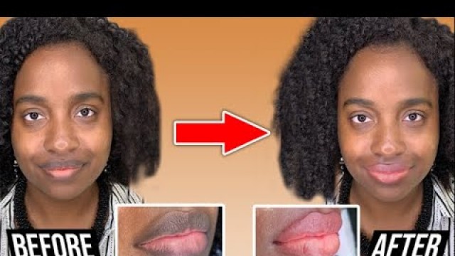 'Woman Goes Viral After REM0VING MELANIN From Lips'