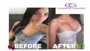 'Breast Augmentation Experience| CG Cosmetics'