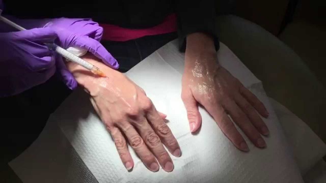 'Hand Rejuvenation with Radiesse'