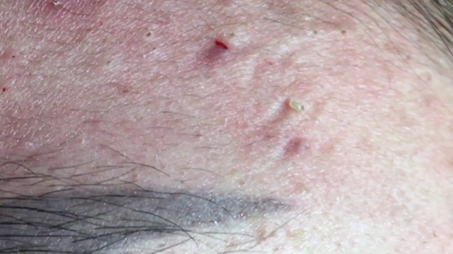 Acne due to sensitivity to cosmetics | 26/02/2020