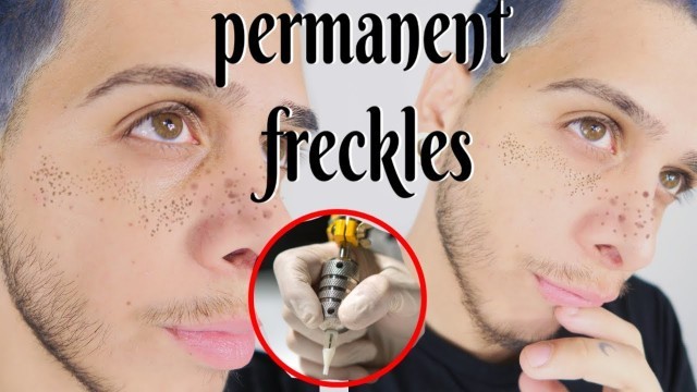 'Permanent Freckles Before & After + 7 Day Healing Process'