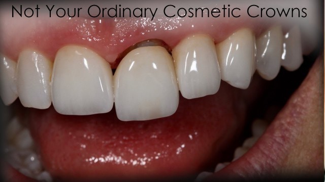 'How To Make Extraordinary Cosmetic Crowns | Dental Lab & Patient Education'