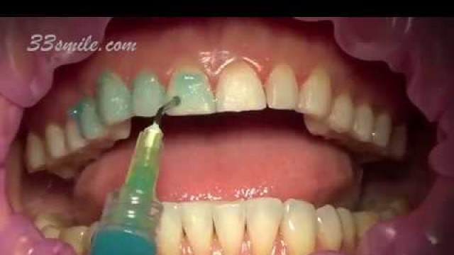 'Prepless Veneers Permanent Teeth Whitening'