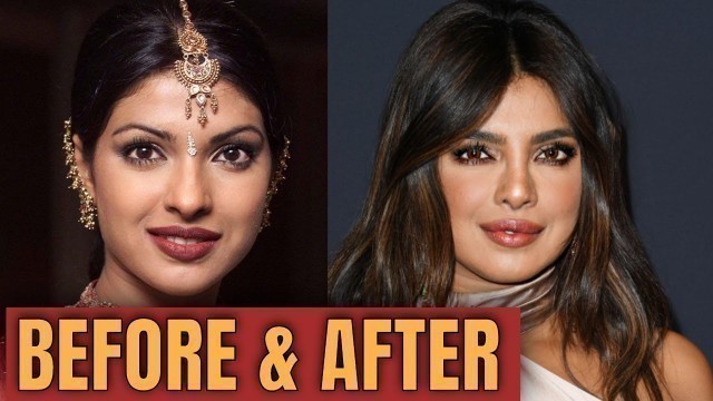 'Priyanka Chopra; Plastic (Cosmetic ) Surgery  2020'