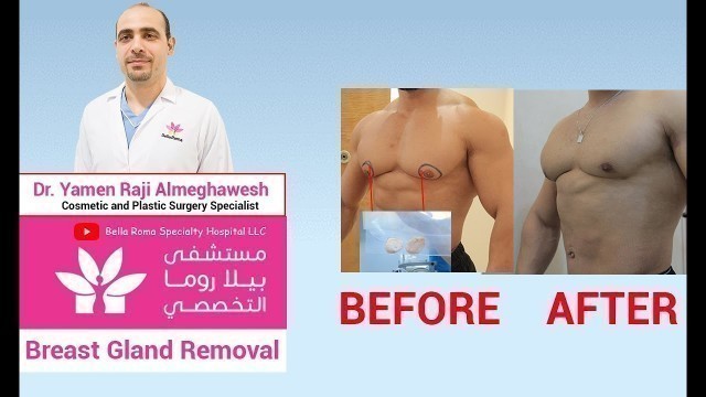 'Male Breast Gland Removal Surgery in Bella Roma Hospital Dubai'