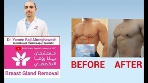 'Male Breast Gland Removal Surgery in Bella Roma Hospital Dubai'