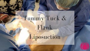 'Tummy Tuck and Flank Liposuction | Cosmetic Surgery Affiliates'