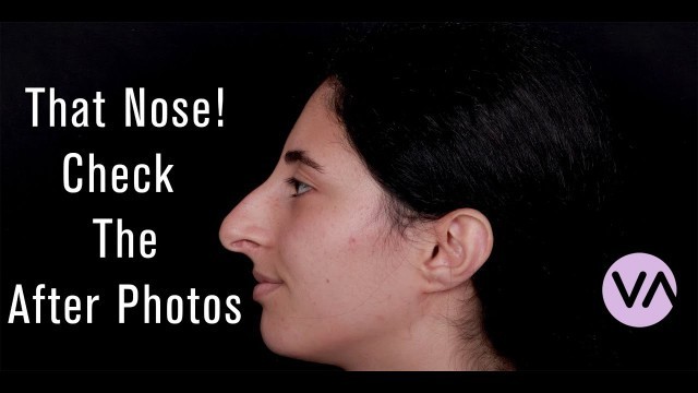 'Rhinoplasty - Amazing Before After Photos from Vanity #rhinoplasty #nosejob'