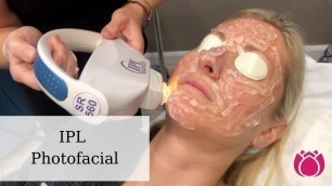 'IPL Photofacial | Cosmetic Surgery Affiliates'