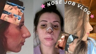 'NOSE JOB VLOG | rhinoplasty experience, price, recovery, before and after!'