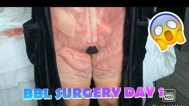 'CG COSMETICS BBL SURGERY DAY 1 | VLOG'