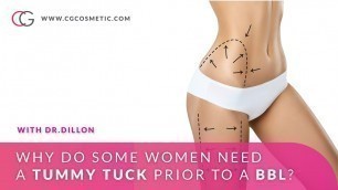 'Why a tummy tuck prior to a BBL? with Dr.Dillon at CG Cosmetic Surgery'