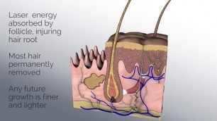 'Spectrum Laser IPL System'